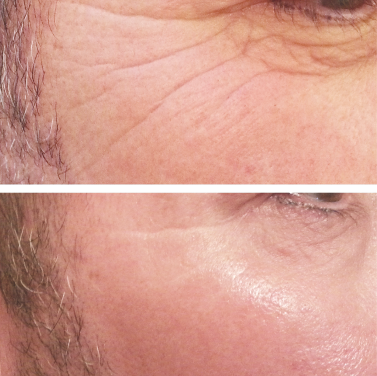 Finishing Touches Meso Skin Needling